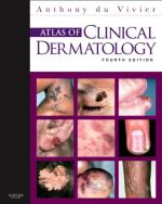 Atlas of Clinical Dermatology 4th Edition By Anthony du Vivier PDF EBOOK EPUB